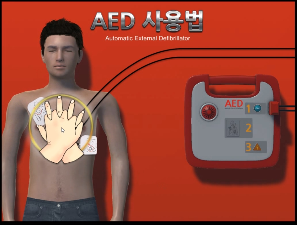 AED 除纤颤器